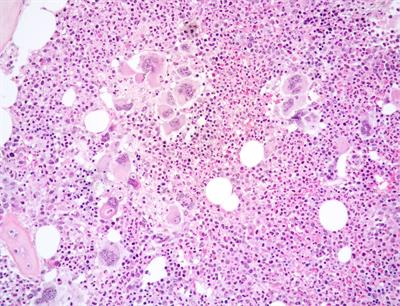 Co-occurrence of JAK2-V617 F mutation and BCR::ABL1 translocation in chronic myeloproliferative neoplasms: a potentially confounding genetic combination